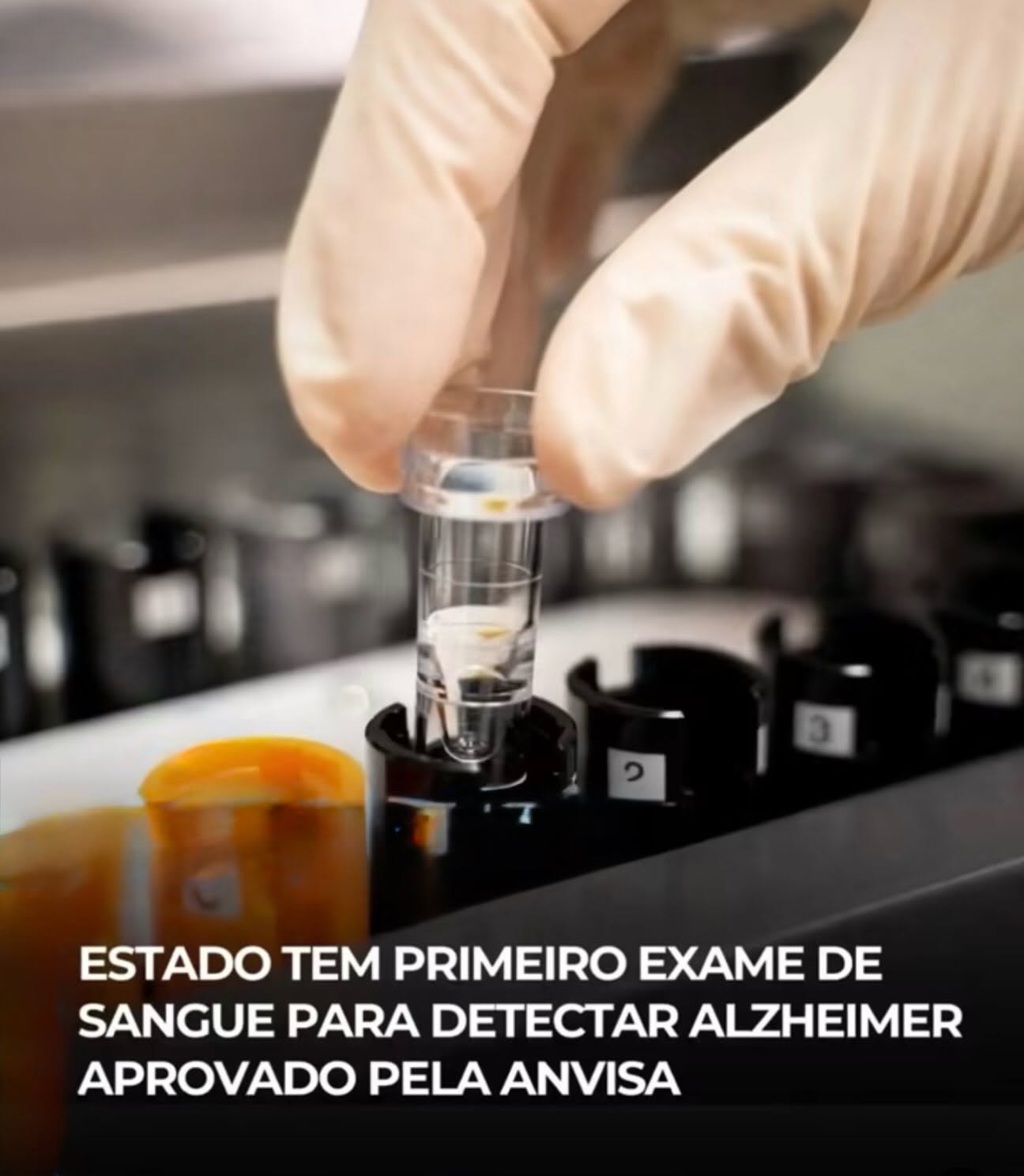ESTADO TEM PRIMEIRO EXAME DE SANGUE PARA DETECTAR ALZHEIMER APROVADO PELA ANVISA